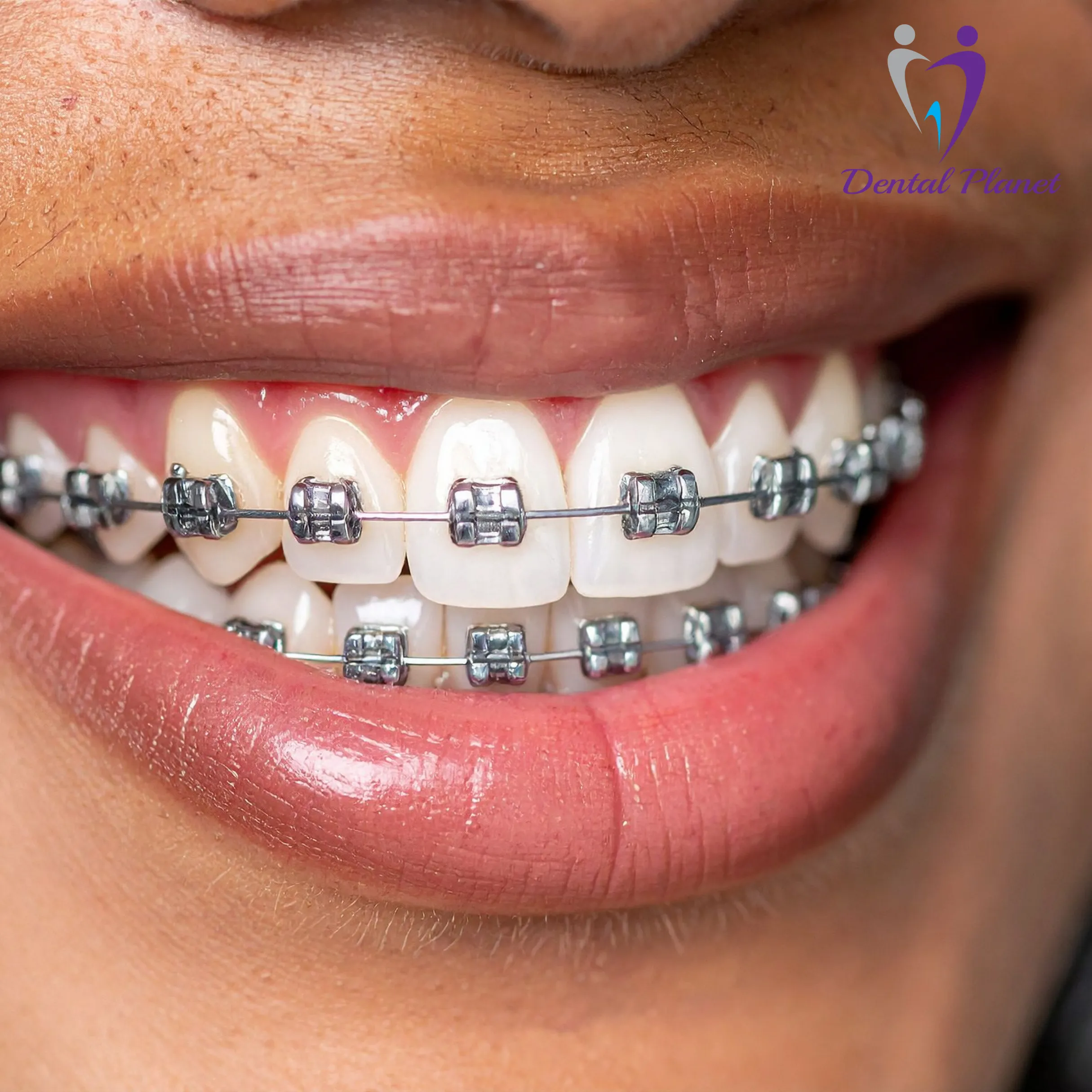 Braces Mysore